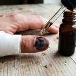 Kako se riješiti tamne mrlje ispod nokta nakon udarca provjerenom metodom kako-se-rijesiti-tamne-mrlje-ispod-nokta-nakon-udarca-provjerenom.webp.webp